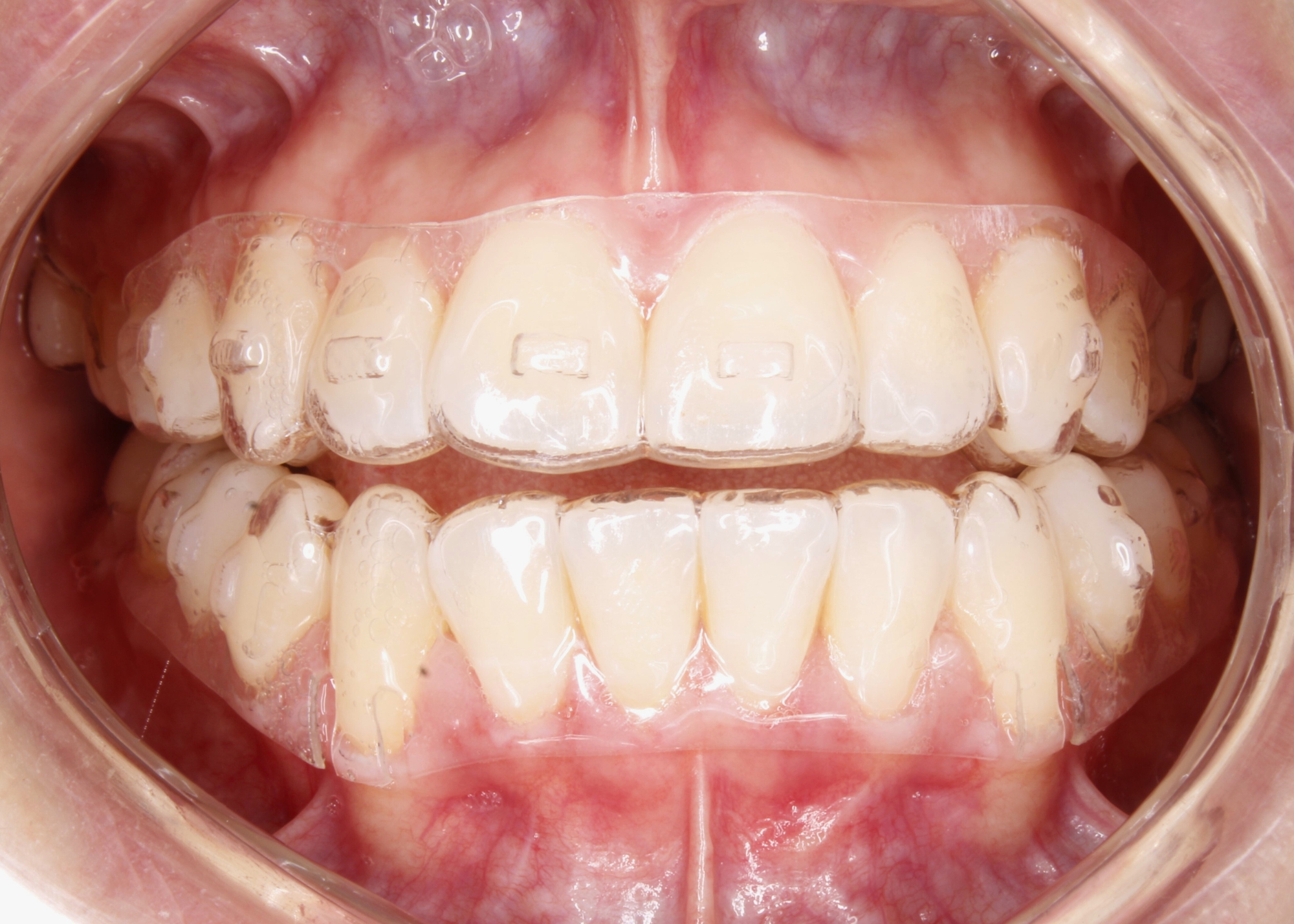 Alineadores Transparentes