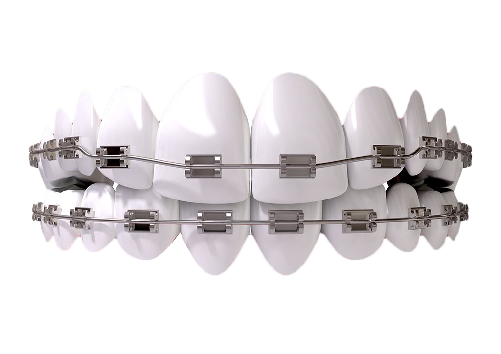 Ortodoncia - Brackets y Alineadores